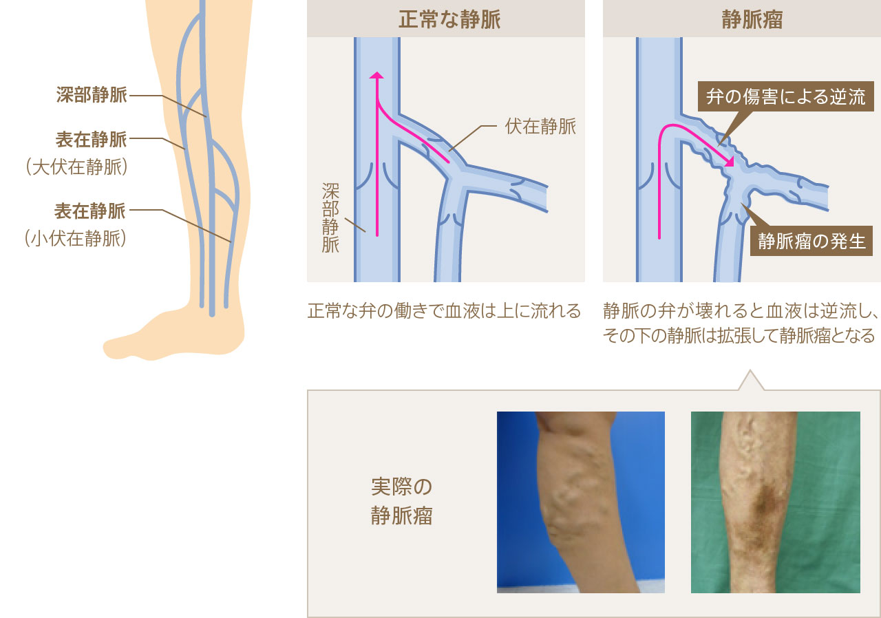 東京都世田谷区で下肢静脈瘤のレーザー治療なら | ゆうハートクリニック